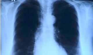 肺结核筛查做什么检查